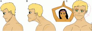 (A) Posterior shift of the head or double chin. (B) Anterior shift of the head or goose neck. (C) Lateral shift of the head: the contralateral shift of the neck to the right allows the patient to have a horizontal gaze despite a tilt of his head to the left. (A) Posterior shift of the head or double chin. (B) Anterior shift of the head or goose neck. (C) Lateral shift of the head: the contralateral shift of the neck to the right allows the patient to have a horizontal gaze despite a tilt of his head to the left.