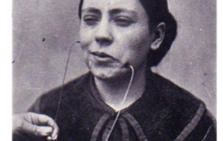 Antagonism Zygomatic major and Depressor anguli oris- Duchenne